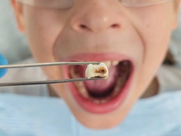 Best Emergency Dental Care for Abscessed Tooth in Goldsboro, NC